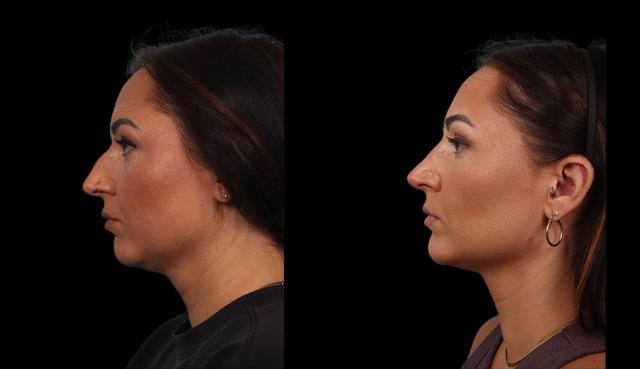 Ethnic Rhinoplasty result at Marietta Plastic Surgery in Marietta, GA