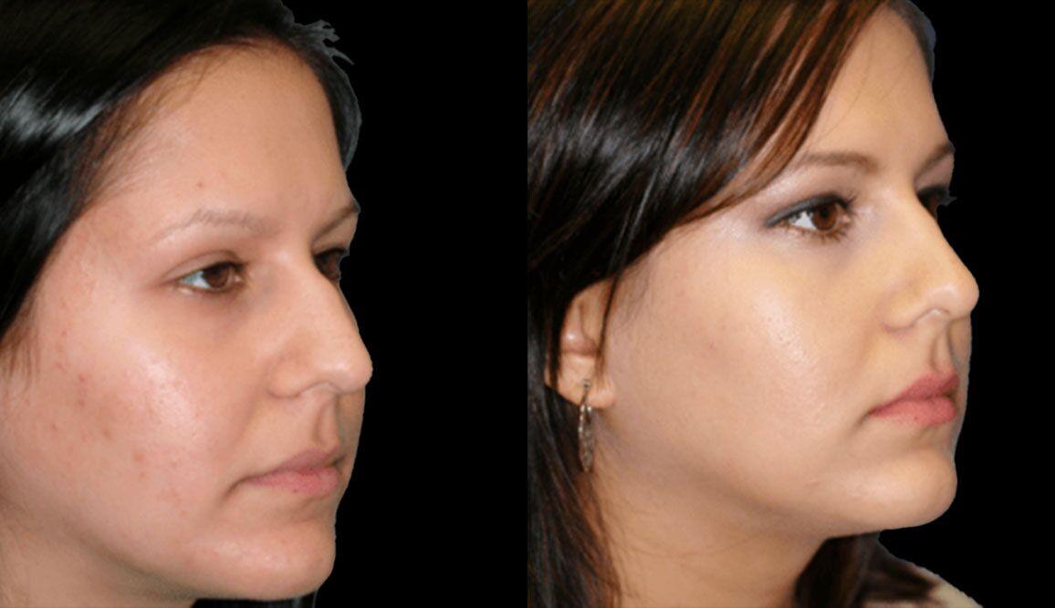 Marietta Plastic Surgery rhinoplasty result — Marietta, GA