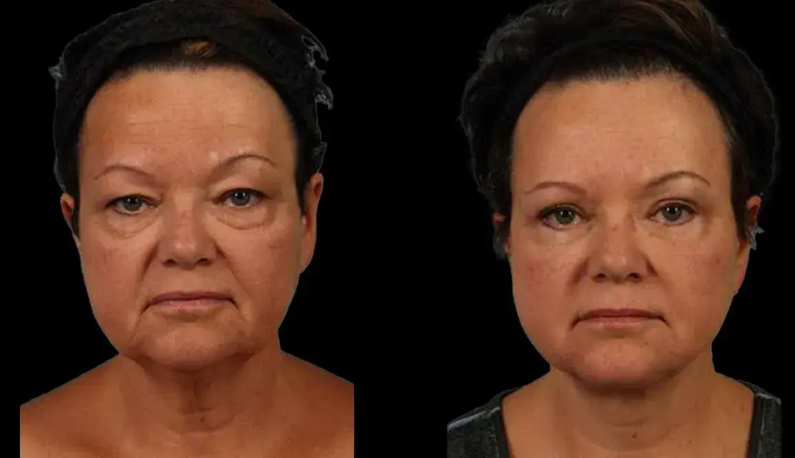 Marietta Plastic Surgery blepharoplasty result — Marietta, GA