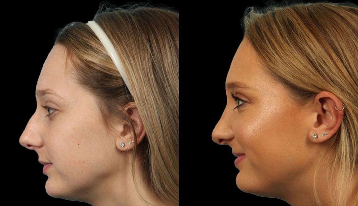 Marietta Plastic Surgery rhinoplasty result — Marietta, GA