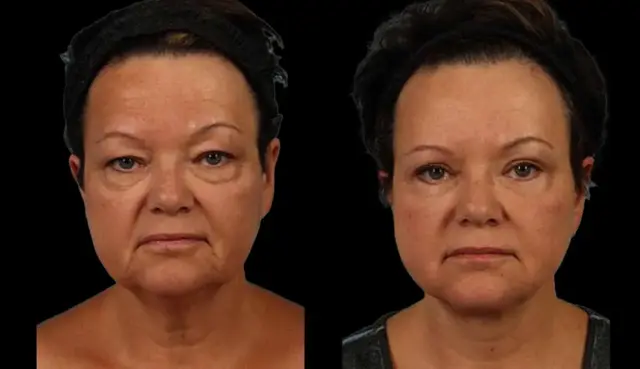Neck Lift result at Marietta Plastic Surgery in Marietta, GA