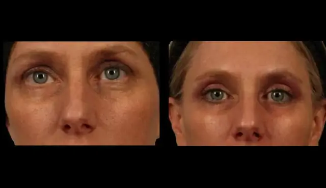 Blepharoplasty result at Marietta Plastic Surgery in Marietta, GA