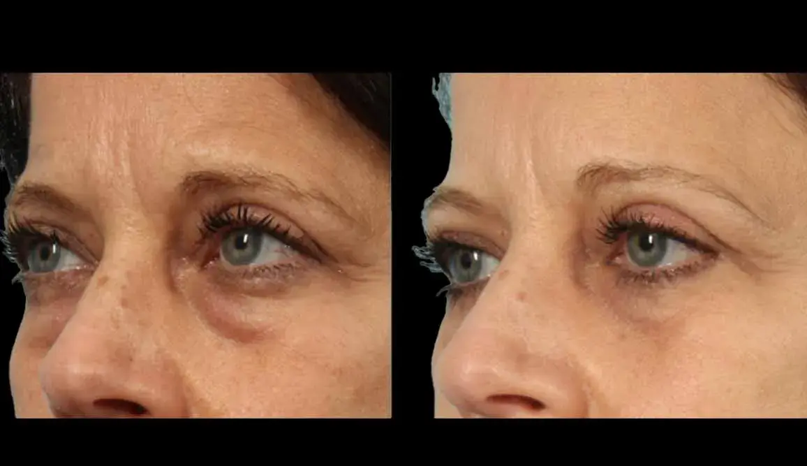 Marietta Plastic Surgery blepharoplasty result — Marietta, GA