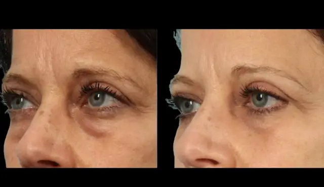 Blepharoplasty result at Marietta Plastic Surgery in Marietta, GA