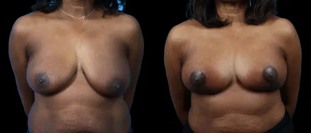 Breast Lift result at Marietta Plastic Surgery in Marietta, GA