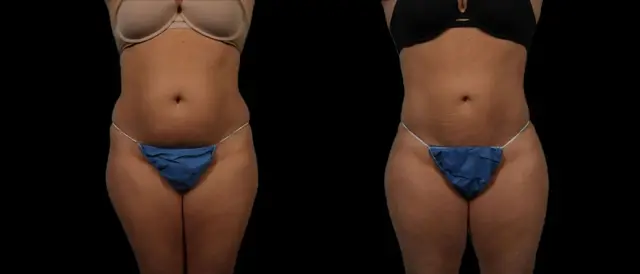 Liposuction result at Marietta Plastic Surgery in Marietta, GA