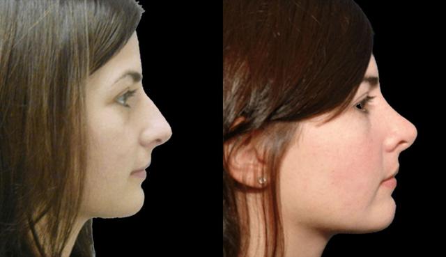 Ethnic Rhinoplasty result at Marietta Plastic Surgery in Marietta, GA