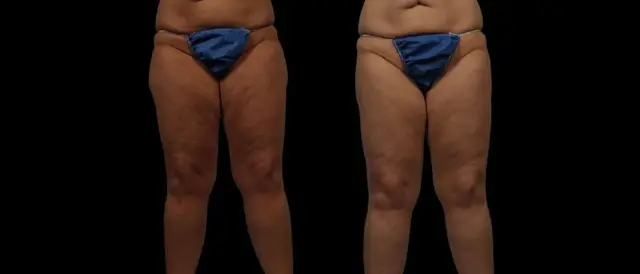 Thigh Lift result at Marietta Plastic Surgery in Marietta, GA