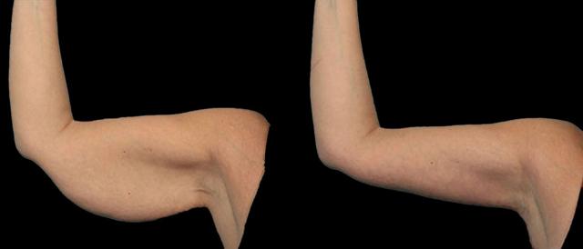 Thigh Lift result at Marietta Plastic Surgery in Marietta, GA