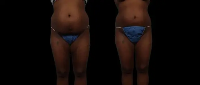 Thigh Lift result at Marietta Plastic Surgery in Marietta, GA