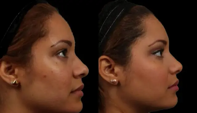 Ethnic Rhinoplasty result at Marietta Plastic Surgery in Marietta, GA