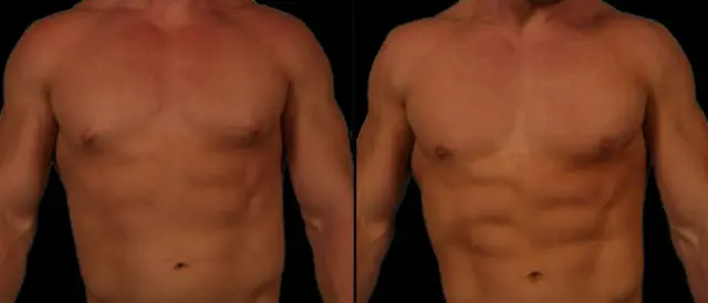 Gynecomastia Surgery result at Marietta Plastic Surgery in Marietta, GA