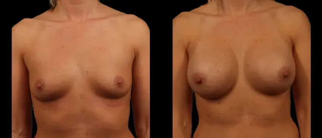 Breast Augmentation result at Marietta Plastic Surgery in Marietta, GA
