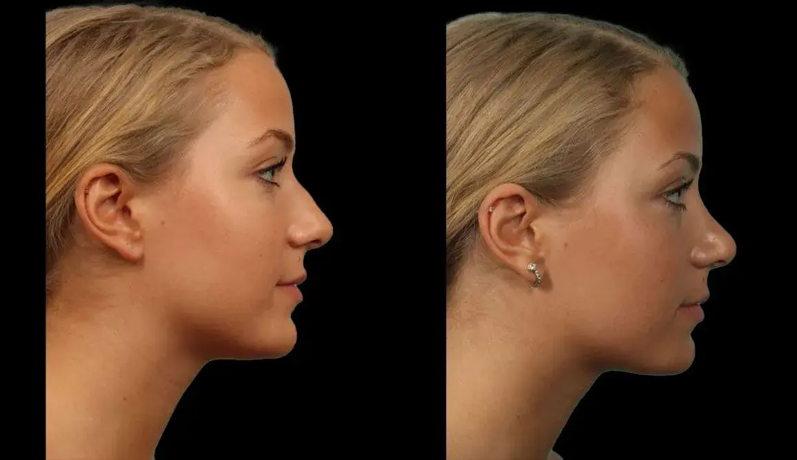 Marietta Plastic Surgery rhinoplasty result — Marietta, GA