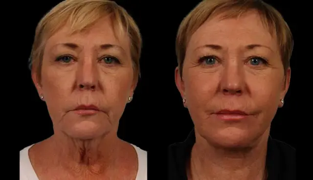 Neck Lift result at Marietta Plastic Surgery in Marietta, GA