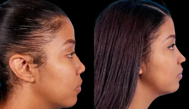 Ethnic Rhinoplasty result at Marietta Plastic Surgery in Marietta, GA