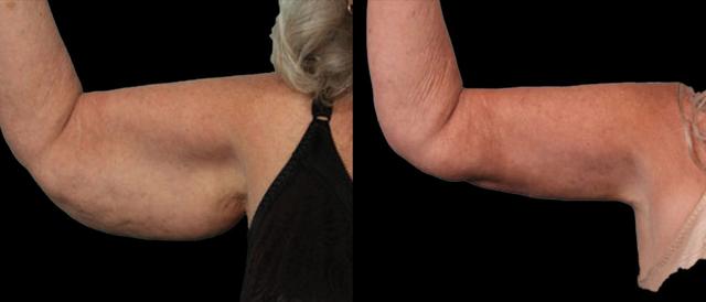 Thigh Lift result at Marietta Plastic Surgery in Marietta, GA