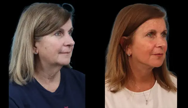 Neck Lift result at Marietta Plastic Surgery in Marietta, GA