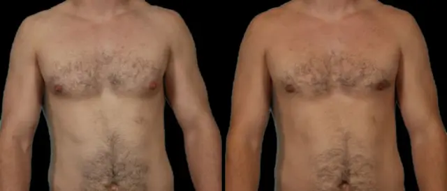 Gynecomastia Surgery result at Marietta Plastic Surgery in Marietta, GA