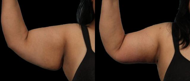 Thigh Lift result at Marietta Plastic Surgery in Marietta, GA