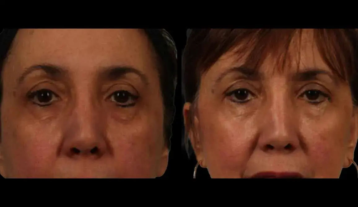 Marietta Plastic Surgery blepharoplasty result — Marietta, GA