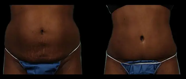 Tummy Tuck result at Marietta Plastic Surgery in Marietta, GA