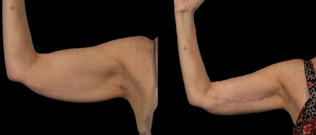 Thigh Lift result at Marietta Plastic Surgery in Marietta, GA