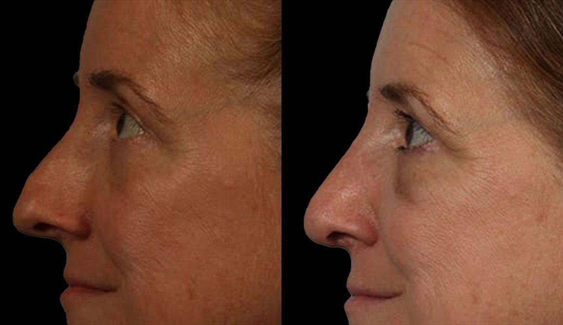 Marietta Plastic Surgery rhinoplasty result — Marietta, GA