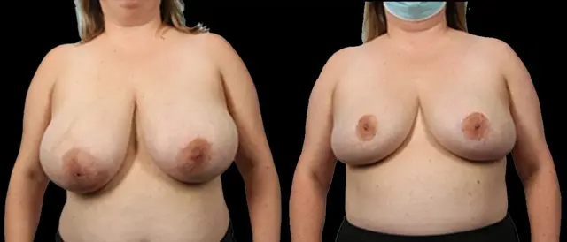 Breast Reduction result at Marietta Plastic Surgery in Marietta, GA