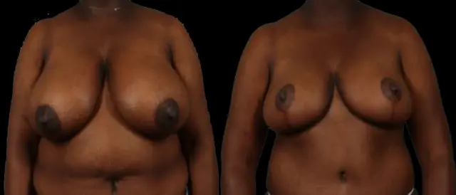 Breast Reduction result at Marietta Plastic Surgery in Marietta, GA