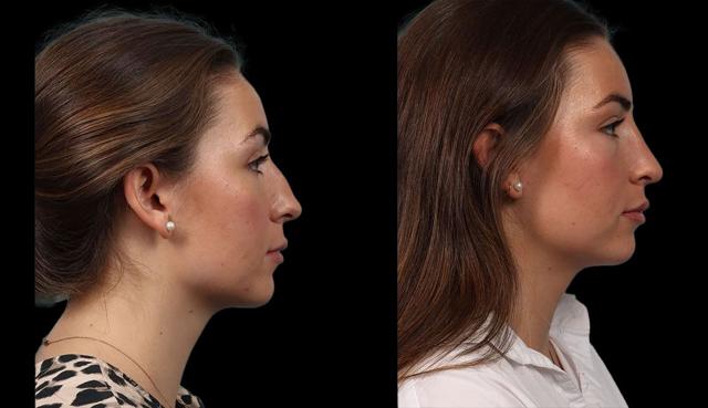 Ethnic Rhinoplasty result at Marietta Plastic Surgery in Marietta, GA