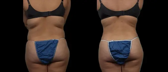 Liposuction result at Marietta Plastic Surgery in Marietta, GA