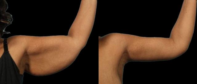 Arm Lift result at Marietta Plastic Surgery in Marietta, GA