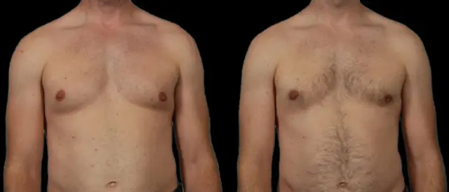 Gynecomastia Surgery result at Marietta Plastic Surgery in Marietta, GA