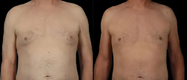 Gynecomastia Surgery result at Marietta Plastic Surgery in Marietta, GA