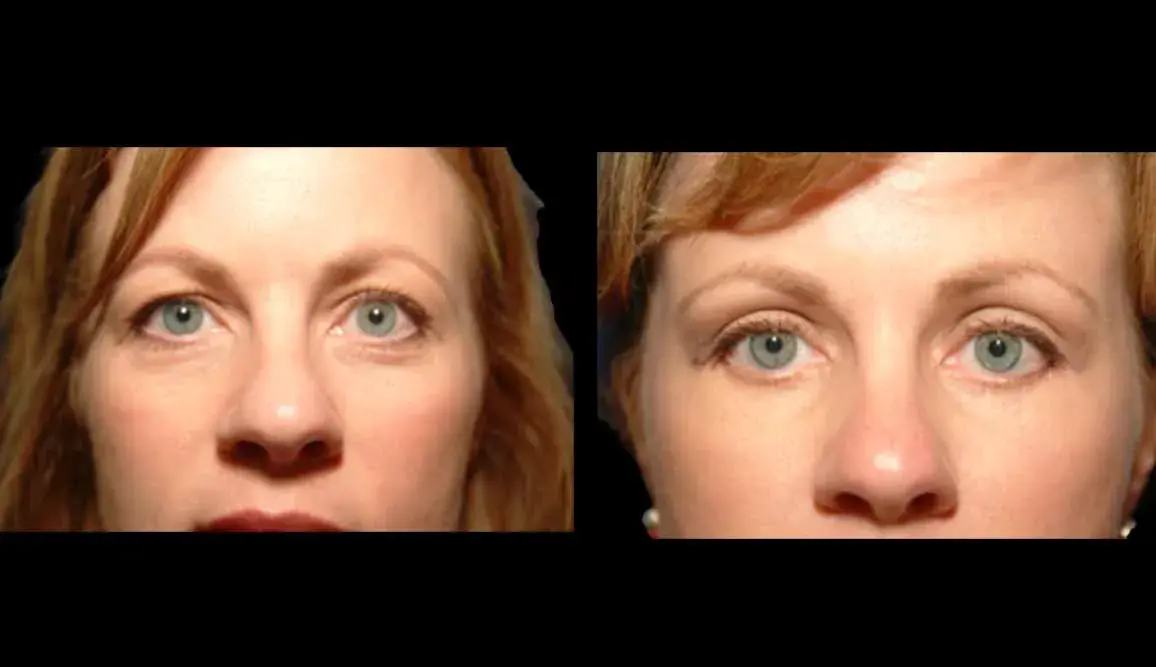 Marietta Plastic Surgery blepharoplasty result — Marietta, GA