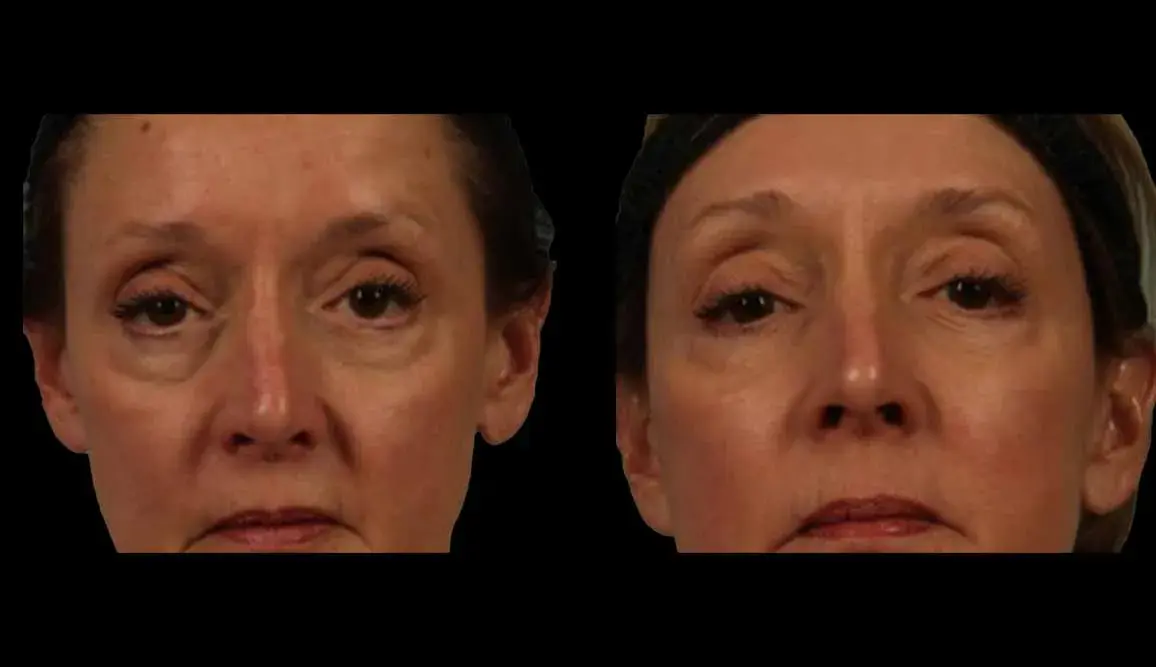 Marietta Plastic Surgery blepharoplasty result — Marietta, GA