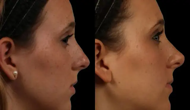 Ethnic Rhinoplasty result at Marietta Plastic Surgery in Marietta, GA