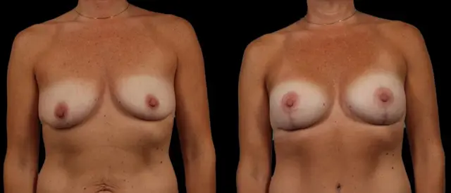 Fat Transfer Breast Augmentation result at Marietta Plastic Surgery in Marietta, GA