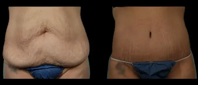 Tummy Tuck result at Marietta Plastic Surgery in Marietta, GA