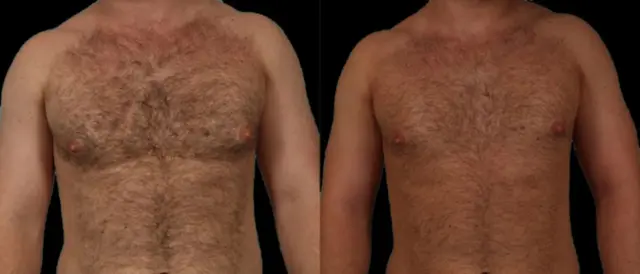 Gynecomastia Surgery result at Marietta Plastic Surgery in Marietta, GA