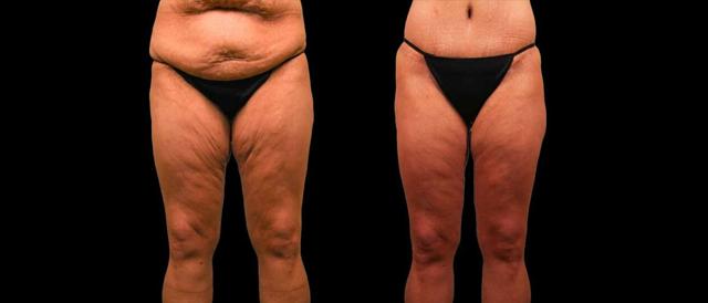Thigh Lift result at Marietta Plastic Surgery in Marietta, GA