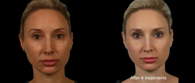 Chemical Peel result at Marietta Plastic Surgery in Marietta, GA