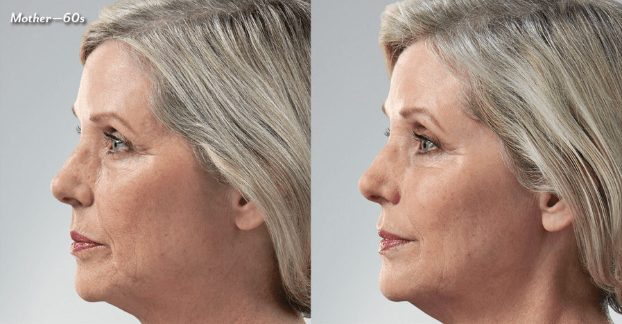 Skin Artisans at Edina Plastic Surgery result — Edina, MN