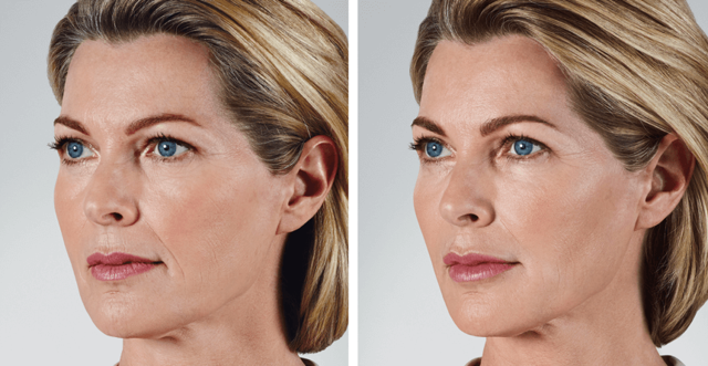 Lip Filler result at Skin Artisans at Edina Plastic Surgery in Edina, MN