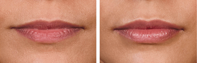 Lip Filler result at Skin Artisans at Edina Plastic Surgery in Edina, MN
