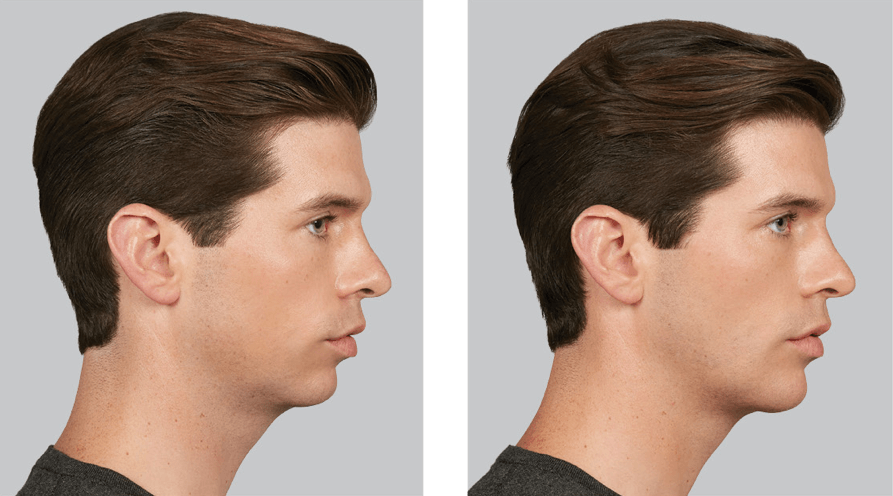 Skin Artisans at Edina Plastic Surgery result — Edina, MN