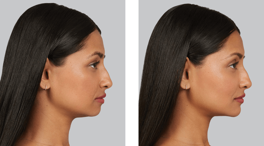 Skin Artisans at Edina Plastic Surgery result — Edina, MN