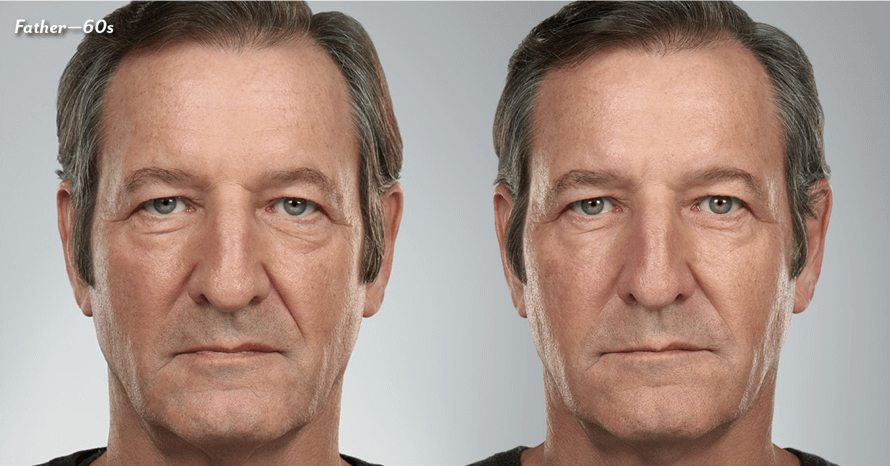 Skin Artisans at Edina Plastic Surgery result — Edina, MN