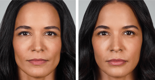 Lip Filler result at Skin Artisans at Edina Plastic Surgery in Edina, MN